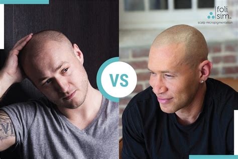 scalp micropigmentation regrets|The 5 Biggest Regrets of Scalp Micropigmentation and How to .